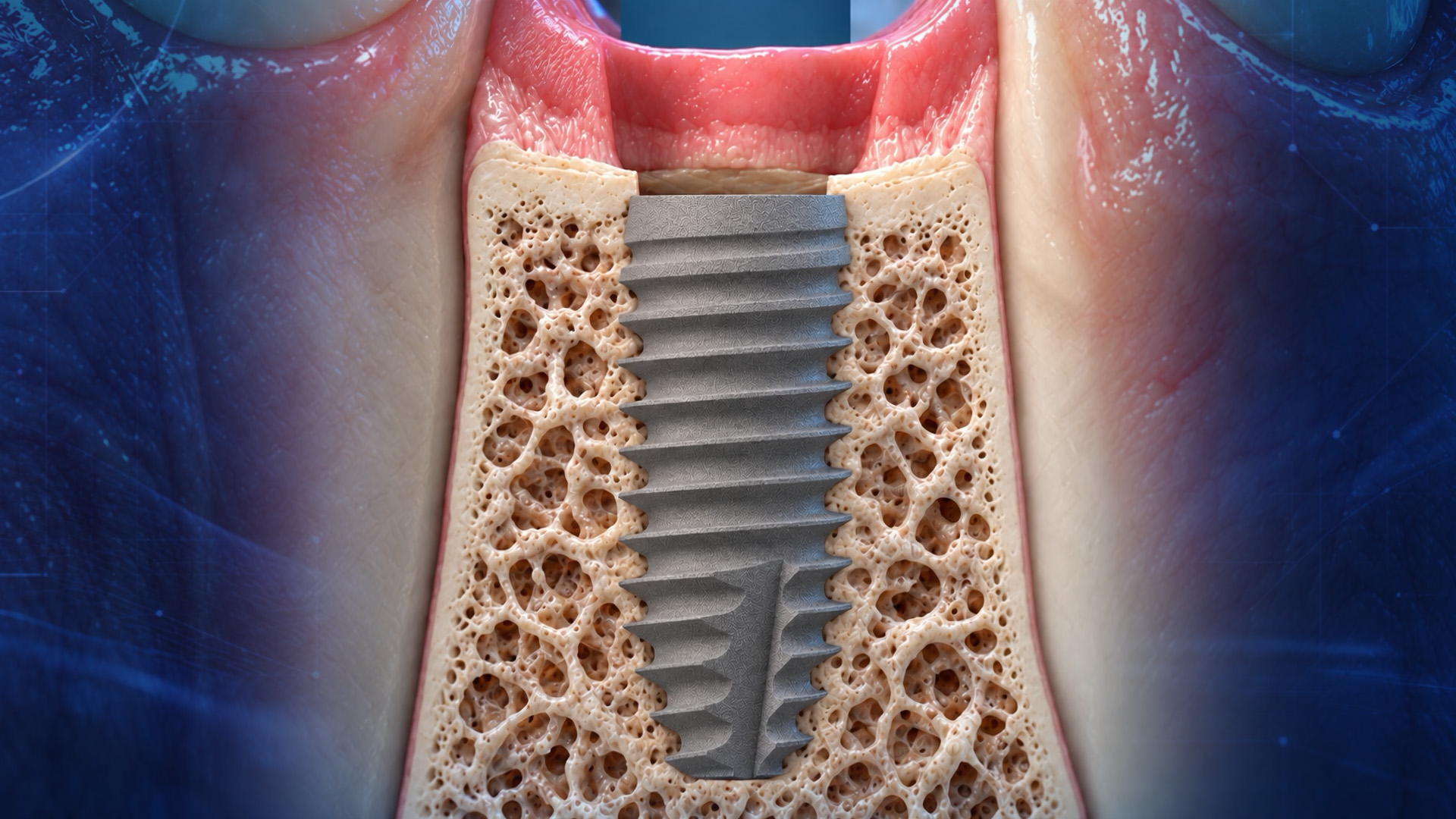 Dental Implant & Bone